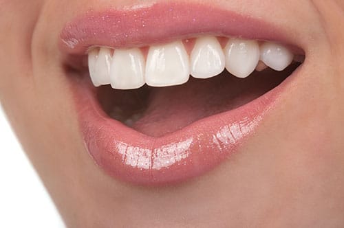 Porcelain Veneers Etobicoke