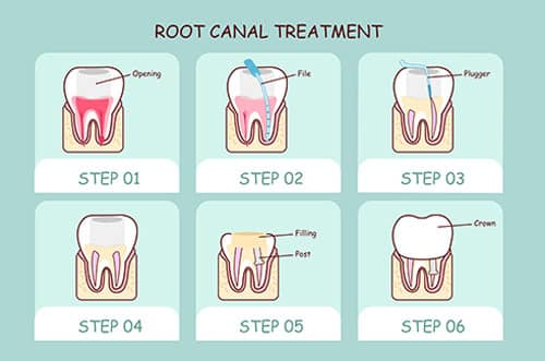 Root Canal Etobicoke