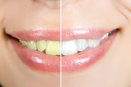 Tooth Whitening Etobicoke