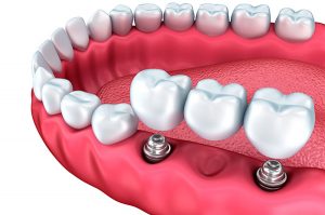 Dental Implants Etobicoke